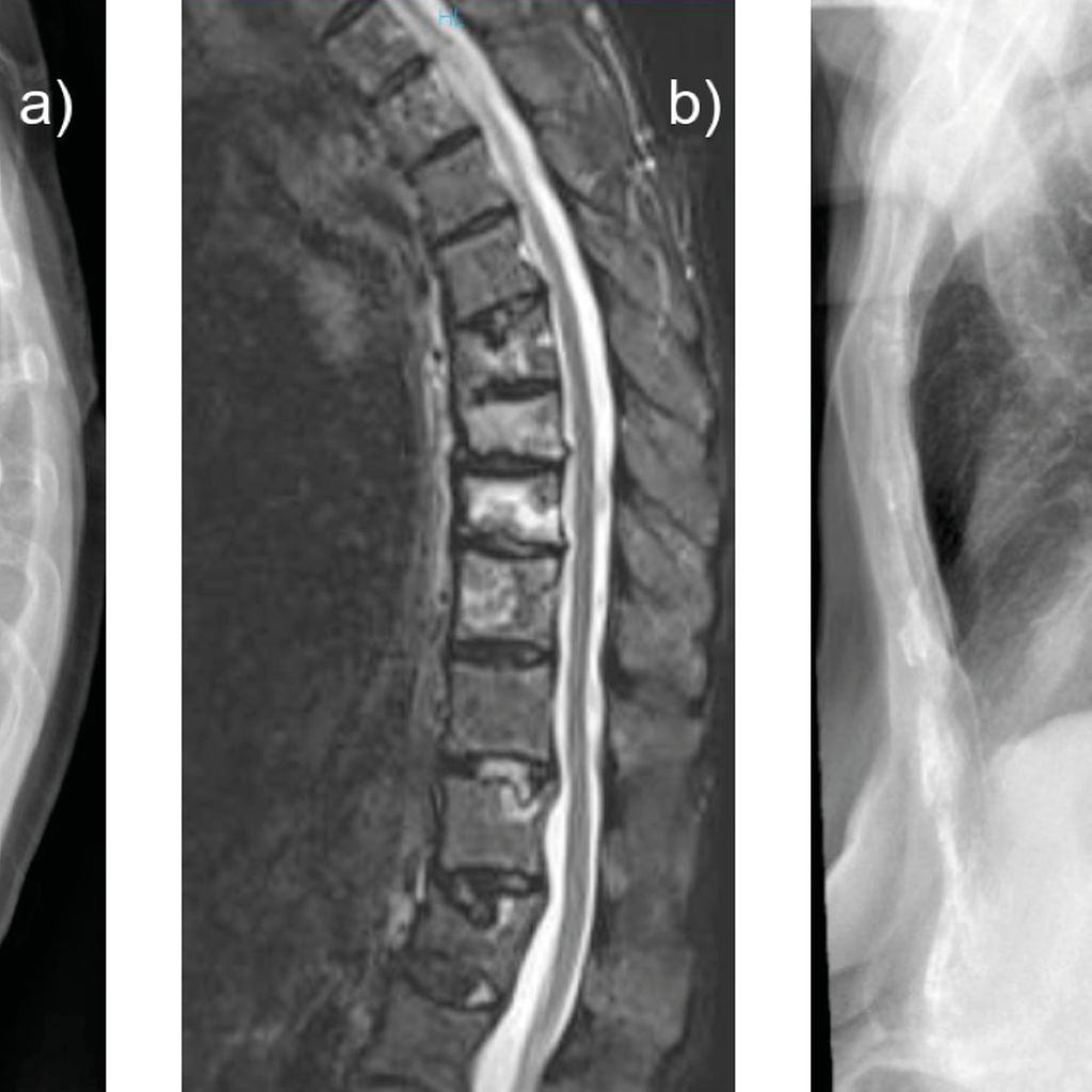 bildgebung-bei-fragilit-tsfrakturen-orthop-die-traumatologie